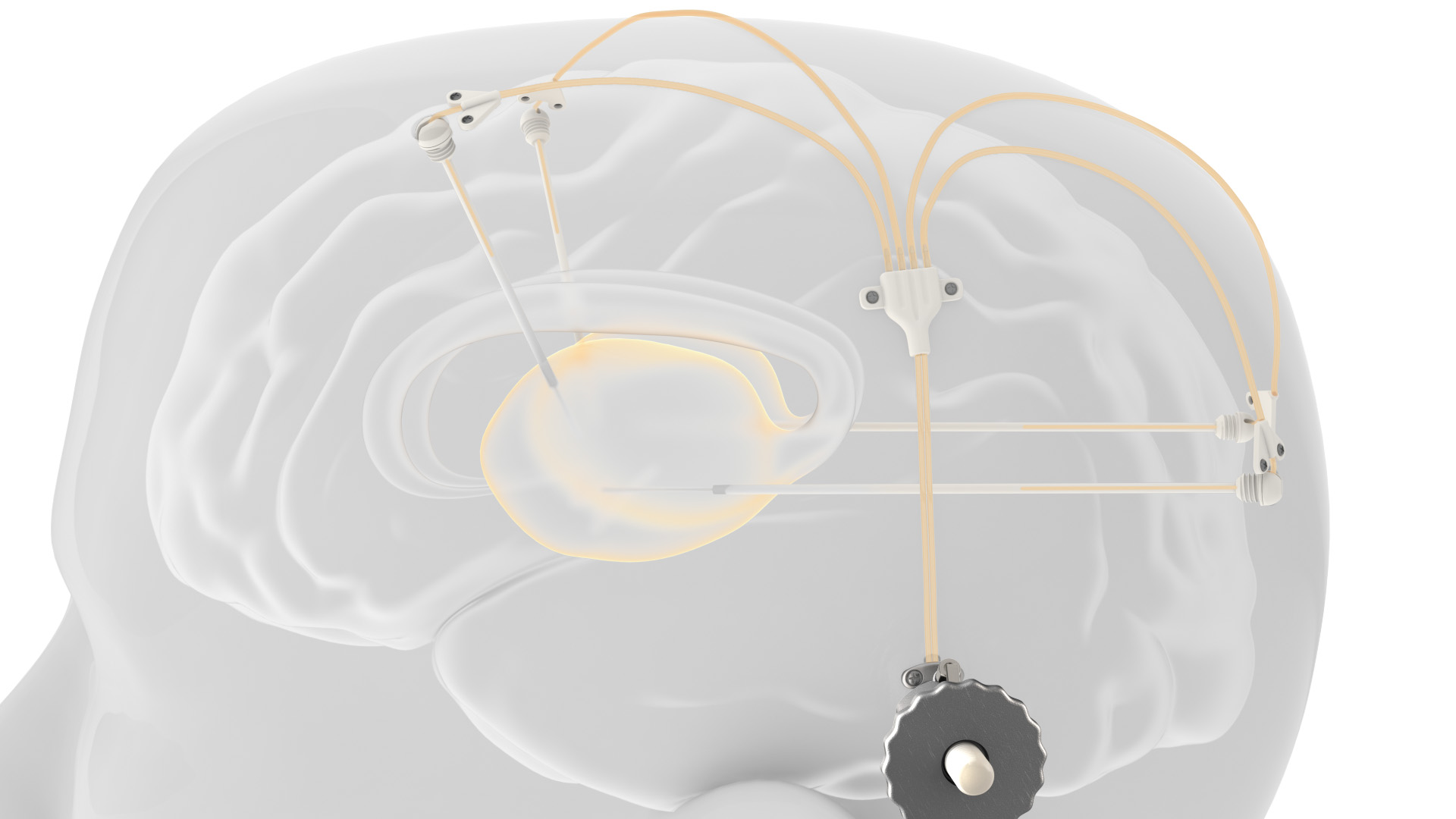 Renishaw_Clinical_Trial_Extension.jpg